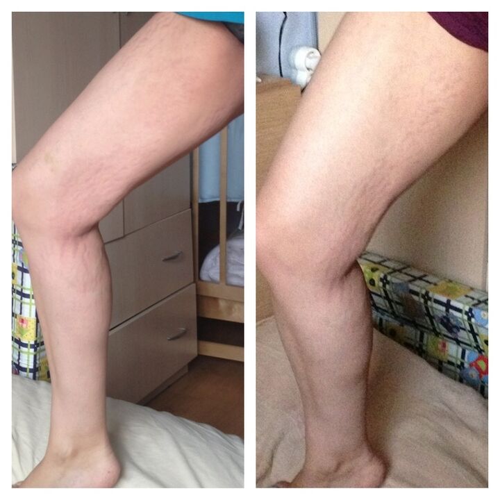 before and after the knee